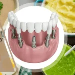 Soft Foods to Eat After Dental Surgery